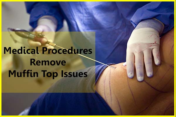 Medical procedures remove muffin top