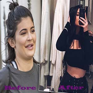 Kylie Kardashian waist trainer result
